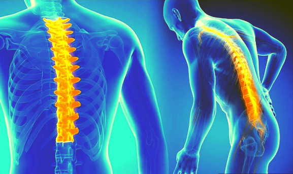 Osteochondrosis of spine