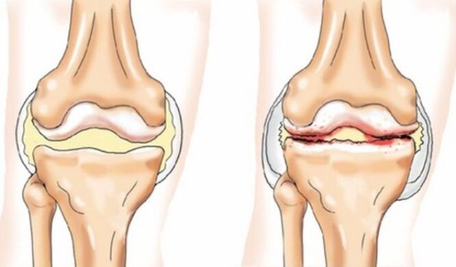 Differences in arthritis and arthritis