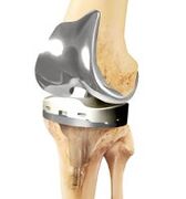 Shared prosthetics