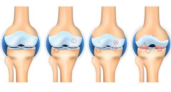 Stages of Osteorthrosis
