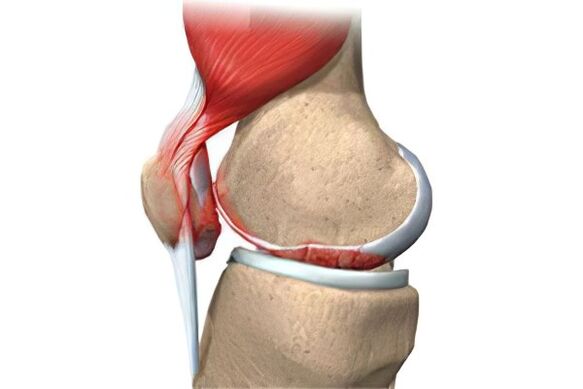 Complications of arthrosis