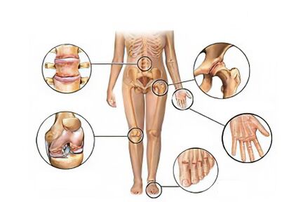 Types of arthrosis