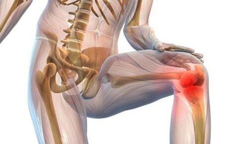 Knee wrist arthrosis