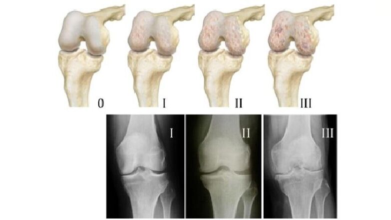 Stages of arthrosis of the knee joint on X-ray images