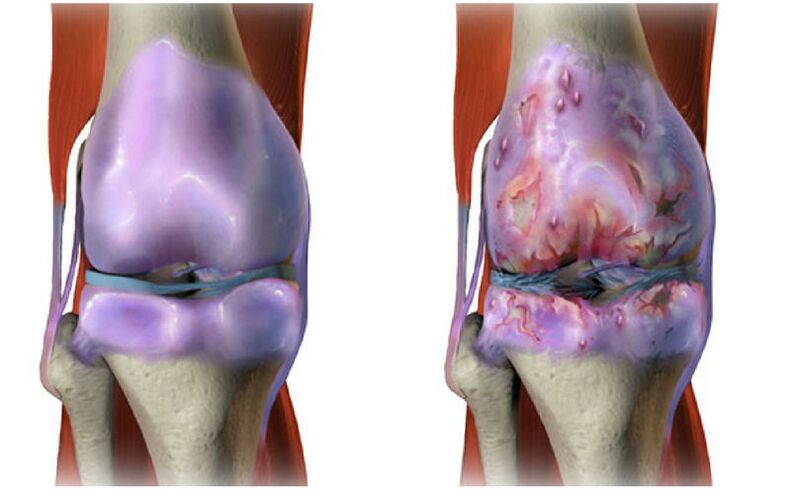 healthy cartilage and destruction of the knee joint in arthrosis