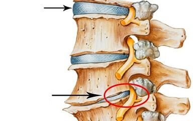 stages of development of cervical osteochondrosis