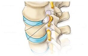 The main symptoms of cervical osteochondrosis