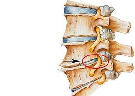 causes of cervical osteochondrosis