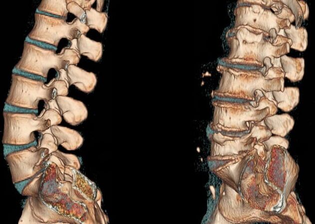 CT of the lumbar spine in normal conditions and in osteochondrosis
