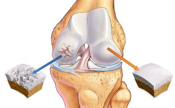 Changes in the joints in arthrosis (left) and normal cartilage (right)
