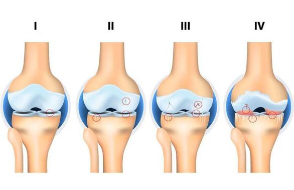 Stages of osteoarthritis development