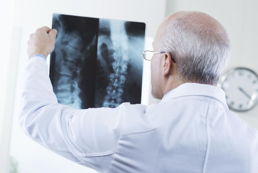 a doctor examines a scan of the cervical spine with osteochondrosis