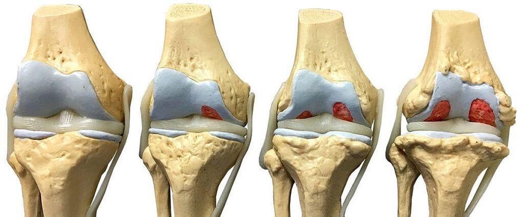 Degrees of knee arthrosis