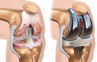 Knee joint endoprosthesis with gonarthrosis